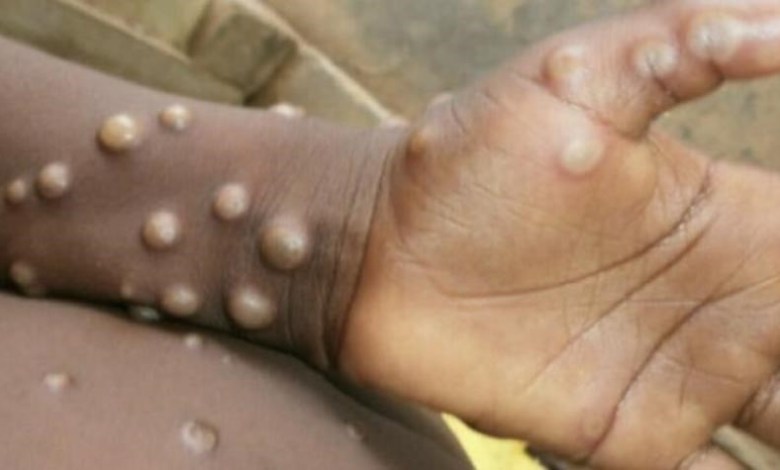 نعمة كبيرة أنعم الله 1 السودان : صحة الخرطوم ترفع درجة التحسب بعد إصابة شاب بجدري القرود في دارفور