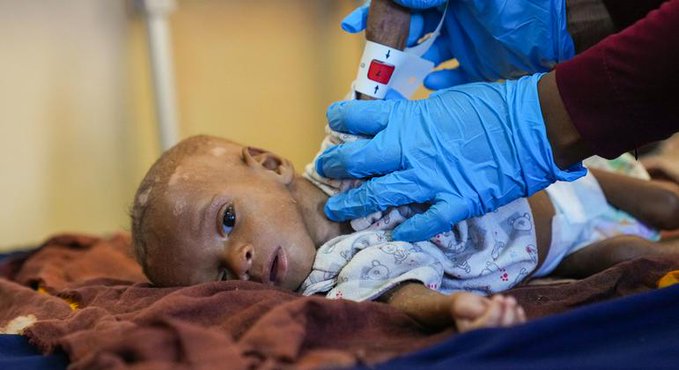 MDVde7qO مأساة إنسانية في القرن الإفريقي .. الجوع ينهش أطفال الصومال