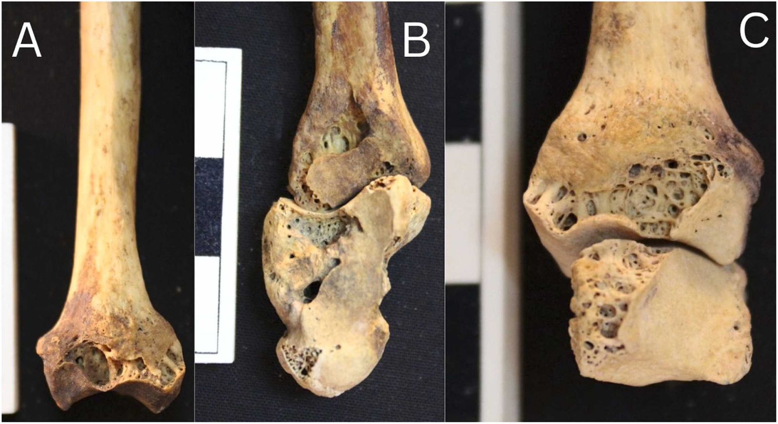 IMG 20240131 WA0002 مصر .. الكشف عن أقدم حالة التهاب المفاصل الروماتويدي في مصر القديمة