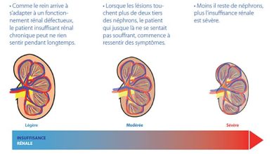أفريقيا: الفشل الكلوي المزمن تحدي متزايد للقارة السمراء 4 maladie renale أفريقيا: الفشل الكلوي المزمن تحدي متزايد للقارة السمراء